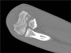 Humerus Fractures - CTisus CT Scan