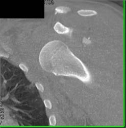 Humerus Fracture-dislocation - CTisus CT Scan