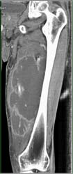 Sarcoma-probably Focal Nodular Hyperplasia (FNH) - CTisus CT Scan