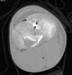 GSW of Knee With Active Bleed From Popliteal Artery - CTisus CT Scan