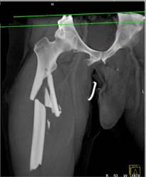 Femur Fractures With Bleed - CTisus CT Scan