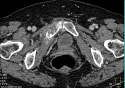 Metastases to Symphysis - CTisus CT Scan