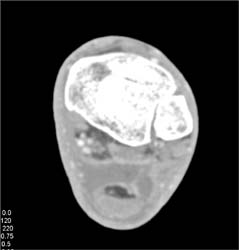 Abscess Adjacent to Achilles Tendon - CTisus CT Scan