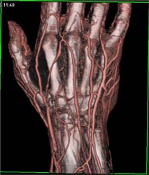 Nice CTA of Hand With Different Renderings - CTisus CT Scan