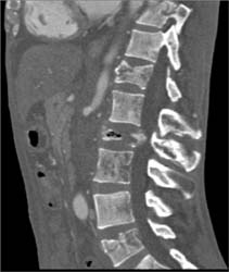 Vertebral Metastases - CTisus CT Scan