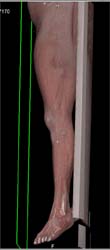 GSW to Thigh With Superficial Femoral Artery (SFA) Trauma - CTisus CT Scan