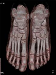 Normal Feet in 3D - CTisus CT Scan