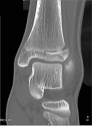 Distal Fracture Through Epiphysis - CTisus CT Scan