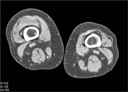 Hemathrosis - CTisus CT Scan