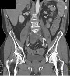 Presacral Abscess - CTisus CT Scan