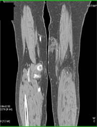 Gastrocnemius Injury - CTisus CT Scan