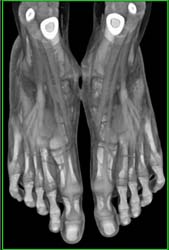 Tendons in 3D - CTisus CT Scan