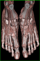 Nice Example of Tendons - CTisus CT Scan