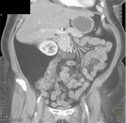 RLQ Liposarcoma - CTisus CT Scan