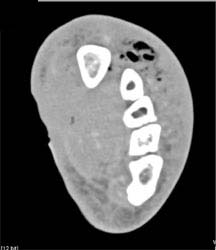 Gas Gangrene With A Number of Various Renderings - CTisus CT Scan