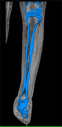 CTA With Bone Edits of Lower Leg With Various Renderings - CTisus CT Scan