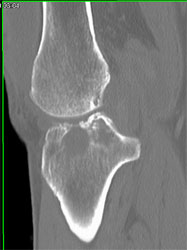 Synovial Cysts - CTisus CT Scan