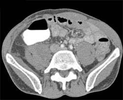 Psoas Abscess Due to Crohn's Disease - CTisus CT Scan