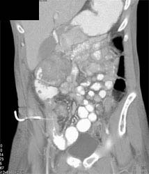 Drainage of Psoas Abscess - CTisus CT Scan