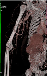 Arteriovenous (AV) Fistulae for Dialysis - CTisus CT Scan