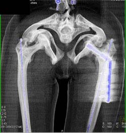 Fractures in Patient With Osteogenesis Imperfecta - CTisus CT Scan