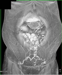 Collaterals Abdominal Wall - CTisus CT Scan