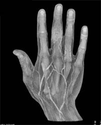 CTA Hand With Multiple Renderings of the Soft Tissues - CTisus CT Scan