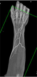 CTA Forearm With Lighting Model Changes - CTisus CT Scan