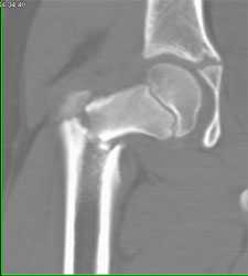 Femur Fracture With Multiple Renderings - CTisus CT Scan