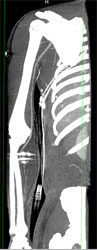 GSW Shoulder Without Vascular Injury - CTisus CT Scan