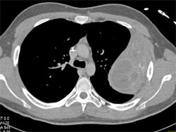 Ewing Sarcoma - CTisus CT Scan