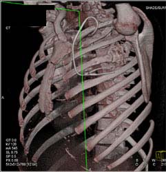 Ewing Sarcoma - CTisus CT Scan