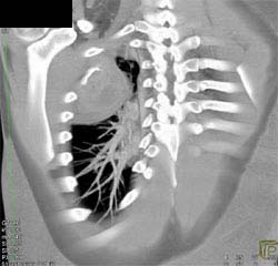 Ewing Sarcoma - CTisus CT Scan