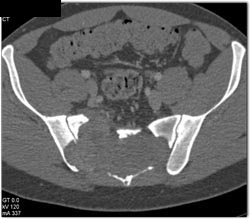 Epidermoid Myxoma - CTisus CT Scan