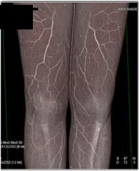 CTA Thigh With Multiple Renderings and Lighting Models - CTisus CT Scan