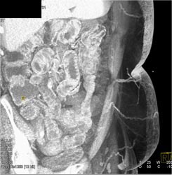 DIEP Flap Planning - CTisus CT Scan