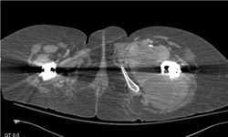 Thigh Hematoma - CTisus CT Scan