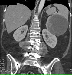 Lymphoma in Right Paraspinal Muscles - CTisus CT Scan