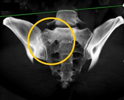 Sacral Fracture - CTisus CT Scan