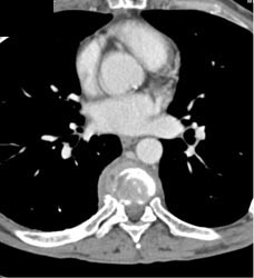 Osteomyelitis to T-spine Due to Tuberculosis (TB) - CTisus CT Scan