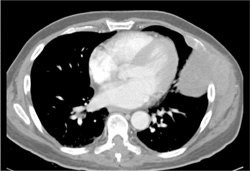 Metastatic Melanoma - CTisus CT Scan