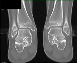 Tarsal Coalition - CTisus CT Scan