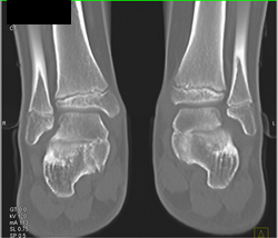 Tarsal Coalition - CTisus CT Scan