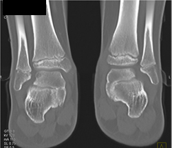 Tarsal Coalition - CTisus CT Scan