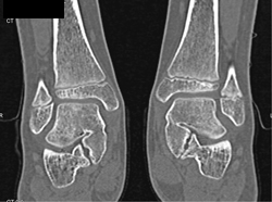 Tarsal Coalition - CTisus CT Scan