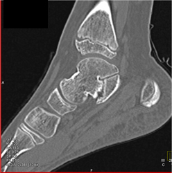 Tarsal Coalition - CTisus CT Scan