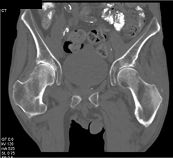 Degenerative Joint Disease (DJD) Hip - CTisus CT Scan