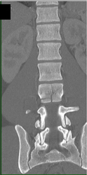 Transverse and Body Fracture - CTisus CT Scan