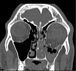 Orbital Fracture - CTisus CT Scan