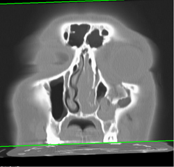 Orbital Fracture - CTisus CT Scan